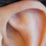 Fístula pré-auricular: Sabe a razão de algumas pessoas terem um furinho na parte de cima da orelha?